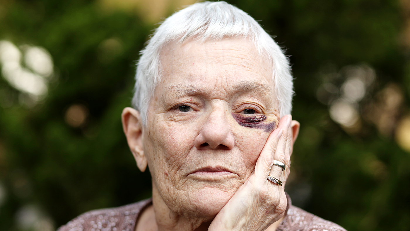 Una donna anziana con un occhio nero.